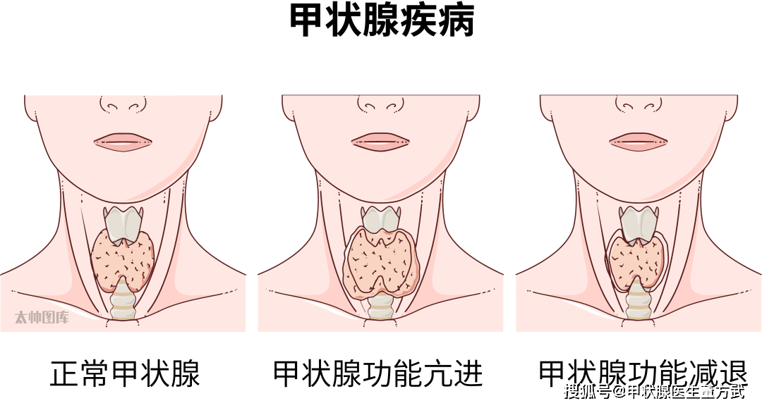 是由于各种原因导致甲状腺激素产生不足或甲状腺激素的作用减弱,从而