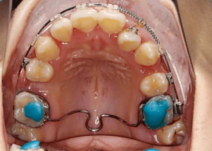 上颌6雕牙教程图解图片