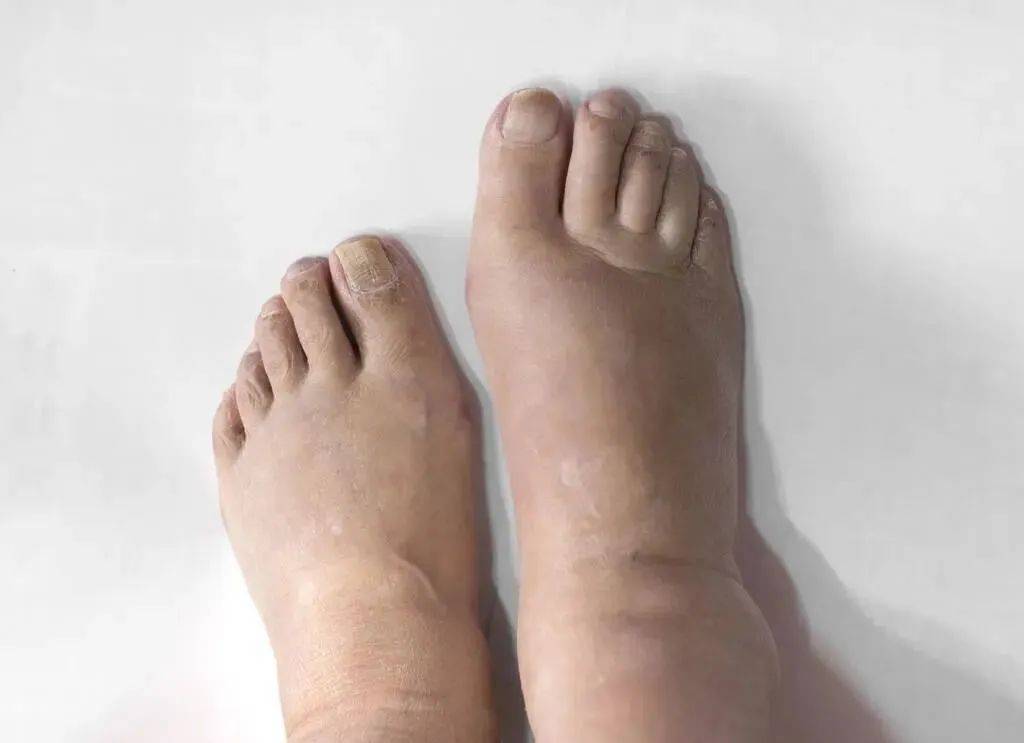 女的脸肿看什么科（妇女脸肿,做什么检查） 女的脸肿看什么科（妇女脸肿,做什么查抄
）《女性脸肿看什么科》 女科知识