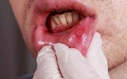 体内有癌,"嘴"先知?提醒:若口腔有5个迹象,建议尽早做筛查