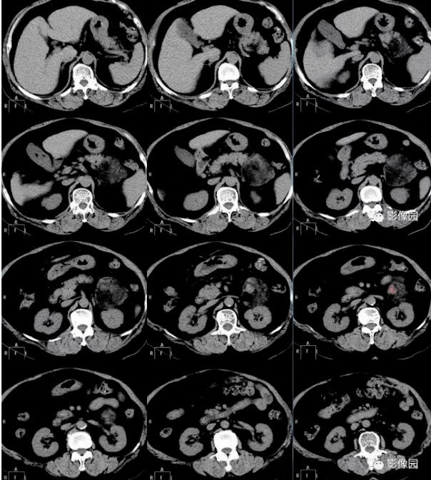 【高尚病例】髓样脂肪瘤1例_肾上腺_肿瘤_症状