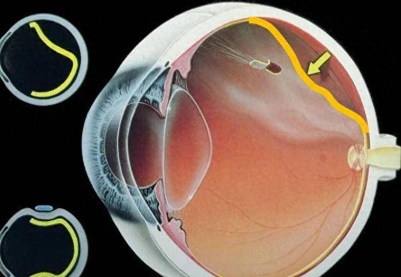 玻璃体切除术后该如何护理?这篇科普告诉你~_视力_患者_生活