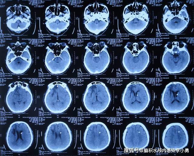 车祸脑外伤术后13天,现脑积水颅内感染致使昏迷,脑脊液鼻漏_给予_治疗