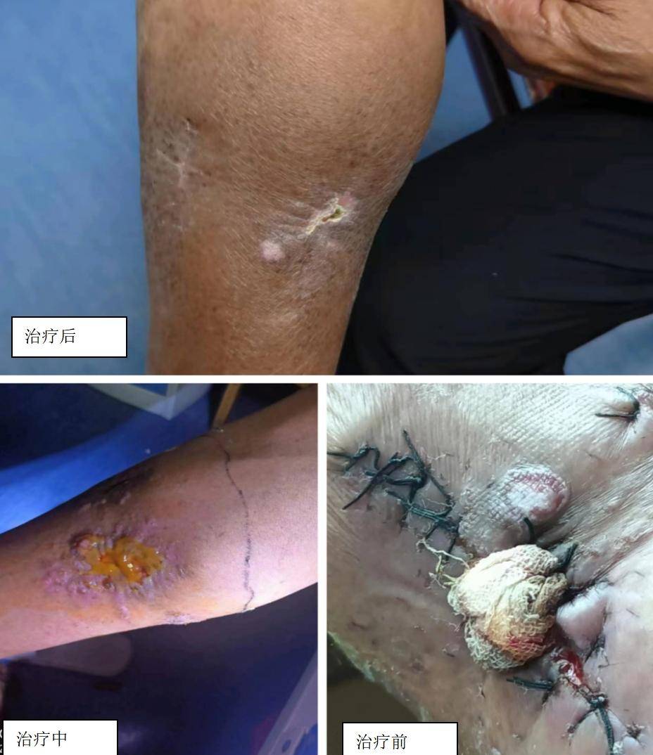 七旬老人腿部出现"皮肤肿块"经久不愈,医生精心救治为其保住腿_肿瘤