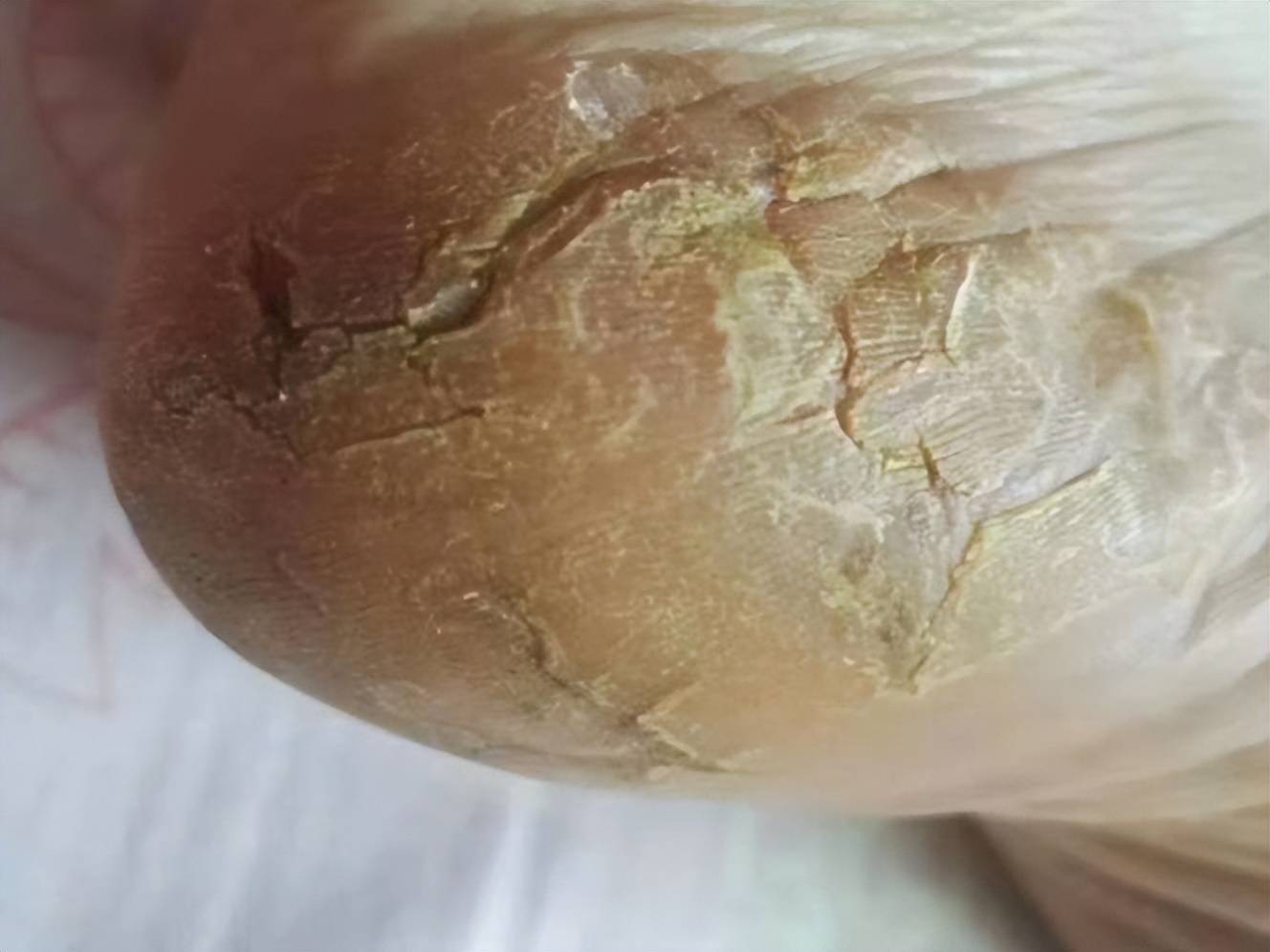 脚后跟开裂渗血不用怕!教你一个小方法轻松解决,省钱又实用!