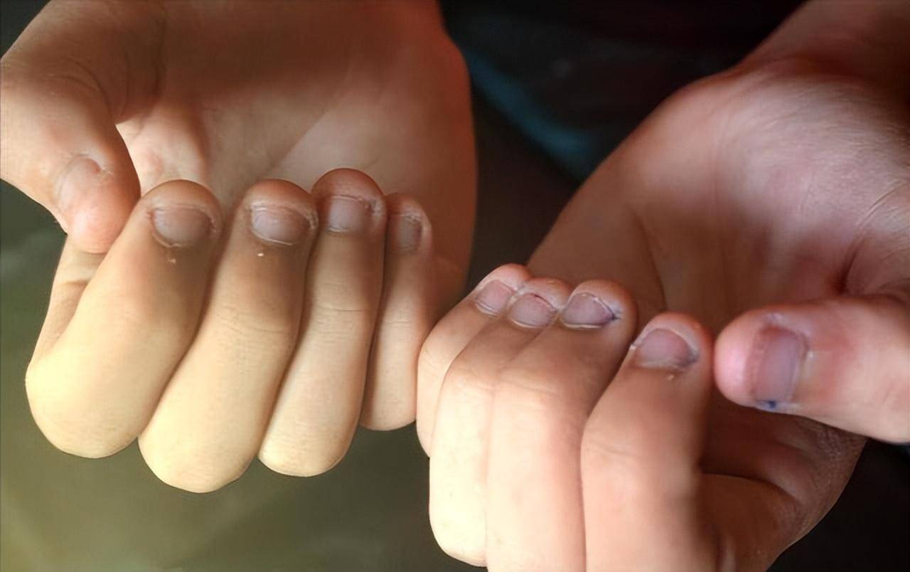 孩子总啃咬指甲,真不是缺维生素,而是在向父母传达这个信号
