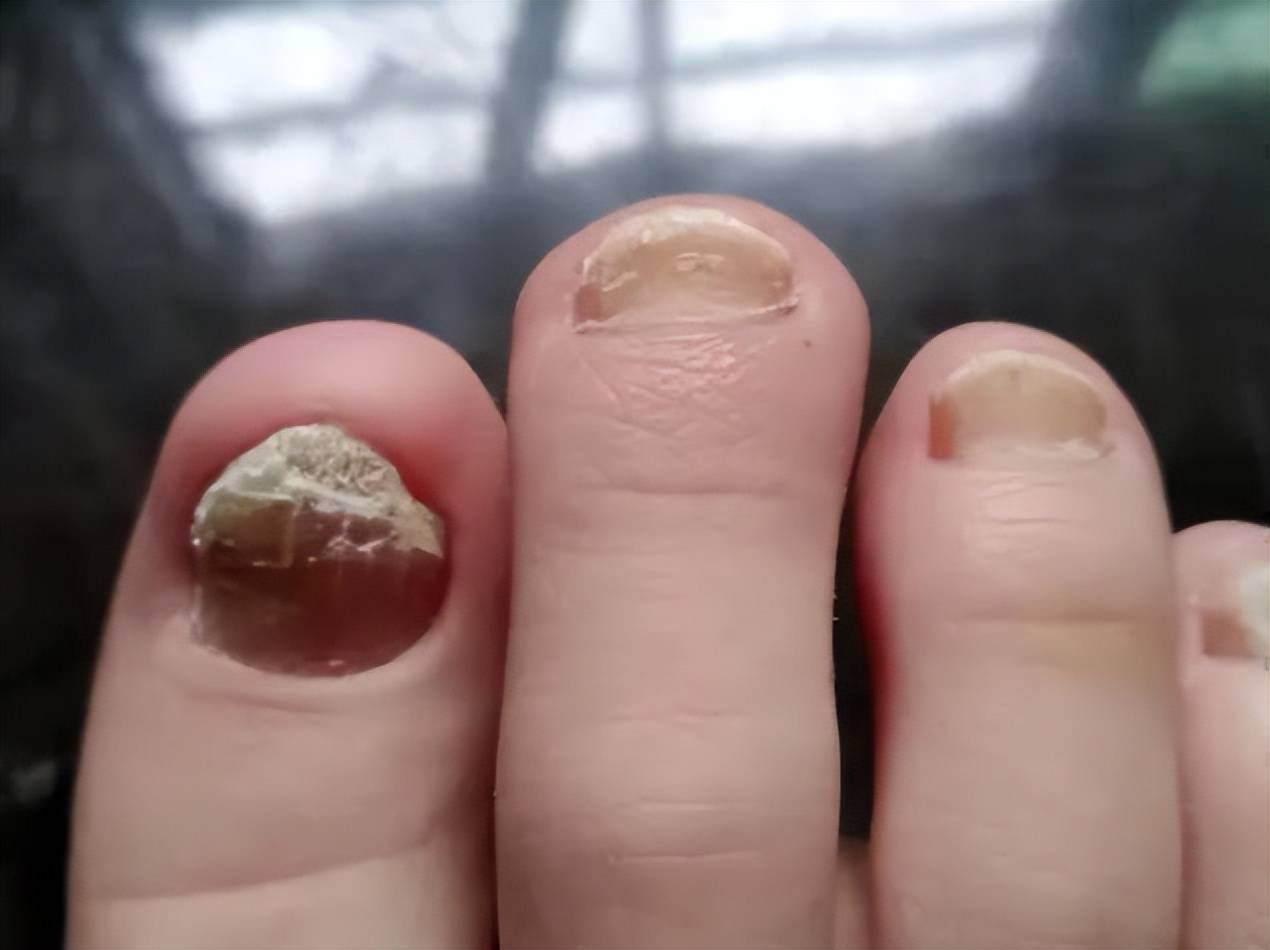 灰指甲是什么 来自搜狐网