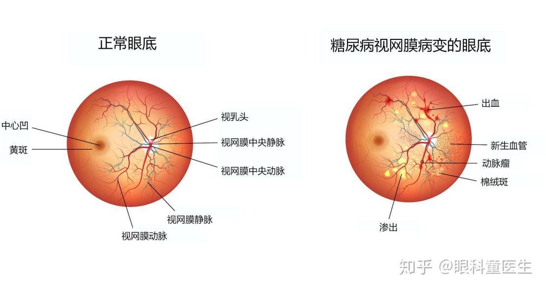 病日 糖友需警惕糖网 平时没症状发病可致盲