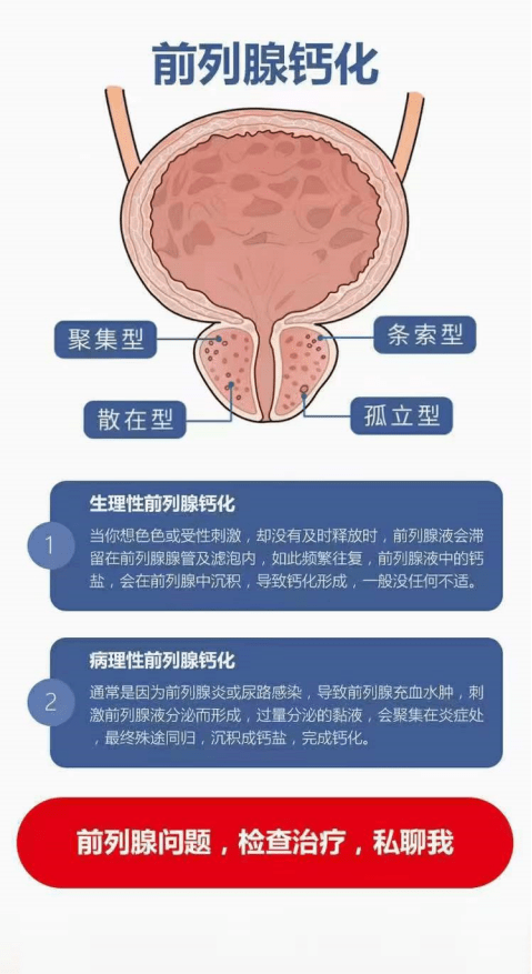 前列腺钙化是前列腺结石的先兆