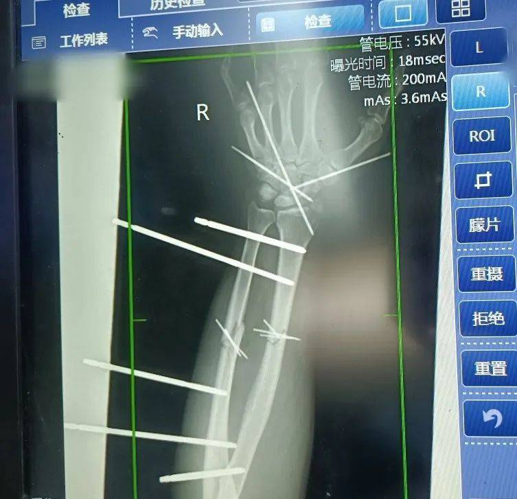 清創傷口,骨折復位固定,在顯微鏡下尋找斷端,縫線標記,固定,肌腱縫合