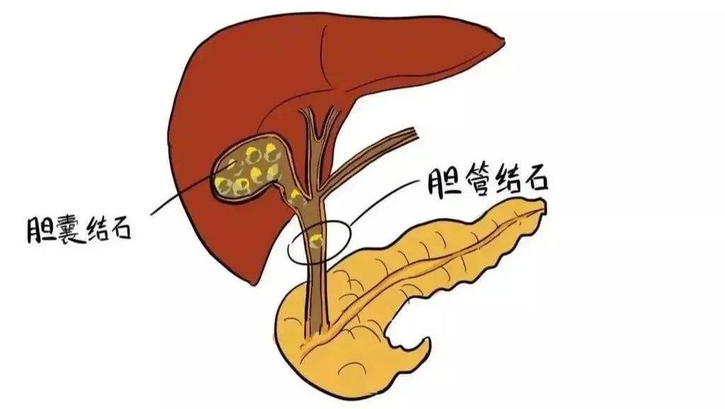 胆囊结石:"小石头"的大问题_治疗_风险_症状