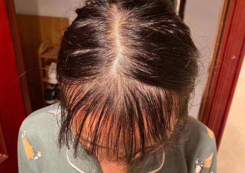 两招效果奇好的防脱生发妙招!_朋友_头皮_洗头