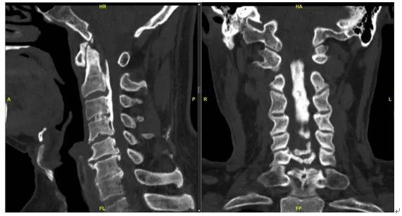 经辅助检查ct示:颈椎后纵韧带钙化,骨性椎管狭窄;颈椎曲度直;颈椎退行