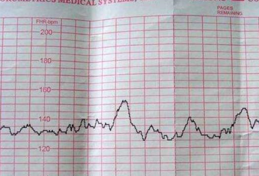 胎心率心率代表的就是胎兒的心跳頻率,之所以在孕期產檢的時候經常都