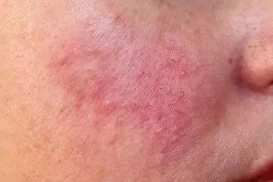 冬季面部皮炎怎么治疗?_手机搜狐网