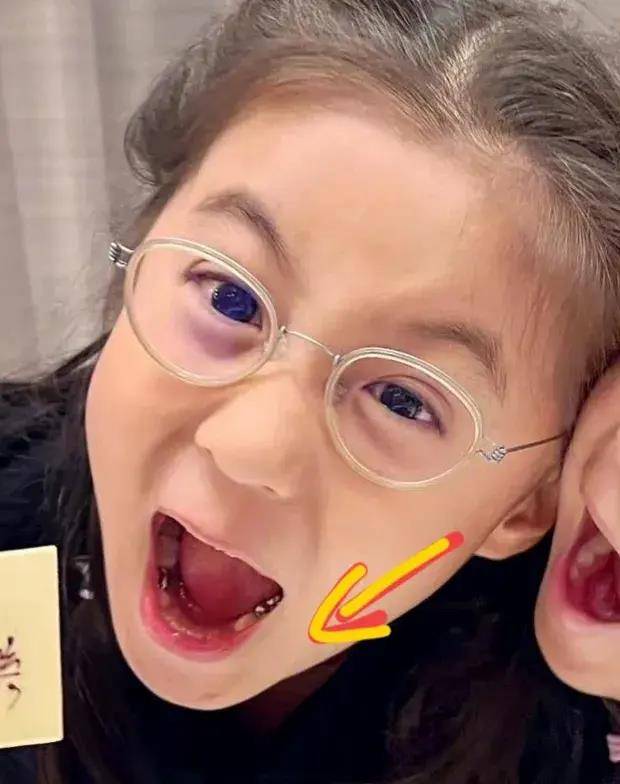 另外,由于咘咘换牙后的牙齿方向影响了她的面部美观