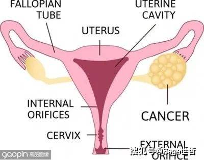 卵巢恶性肿瘤是女性生殖器官常见的恶性肿瘤之一,发病率仅次于子宫颈