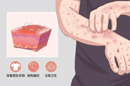 长期"瘙痒",湿疹应该如何治疗?_进行_症状_方式