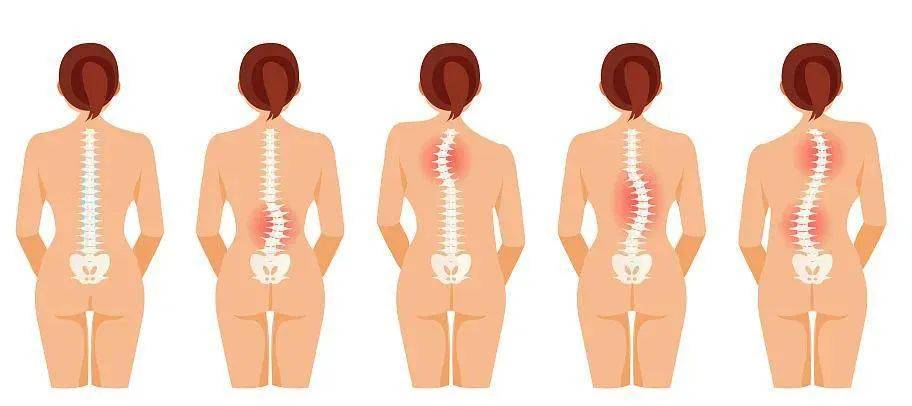 正常人的脊柱从后面看应该是一条直线,并且躯干两侧对称