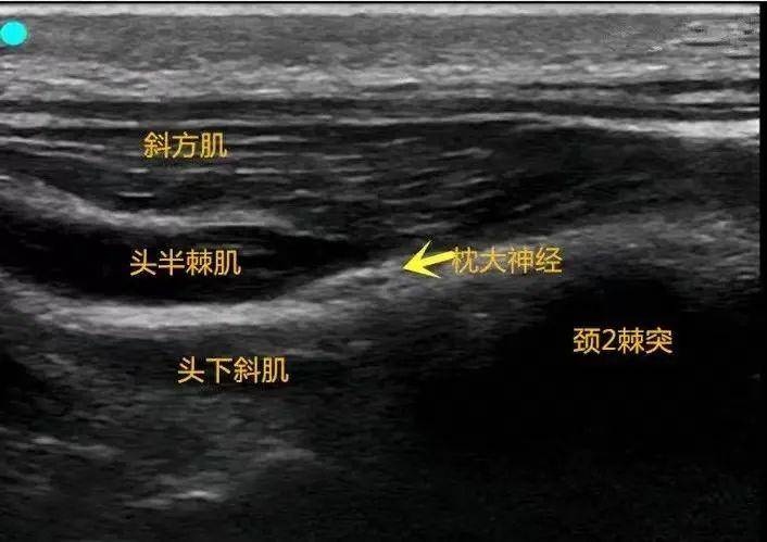 查體:右枕部及乳突壓痛明顯,旋頸試驗陽性,疼痛程度高.