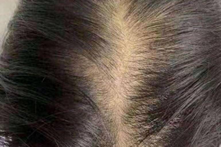 这两招亲测有效!_问题_头皮_因为