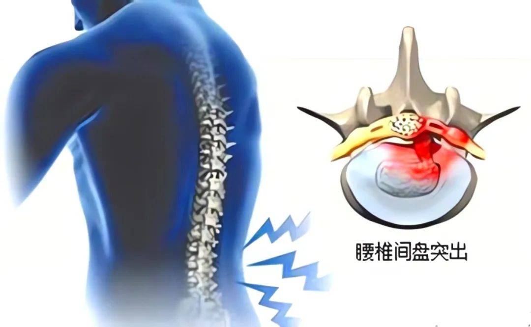 腰椎间盘突出症如何有效缓解疼痛