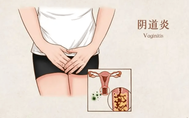 女性尿道口内有颗粒痒图片