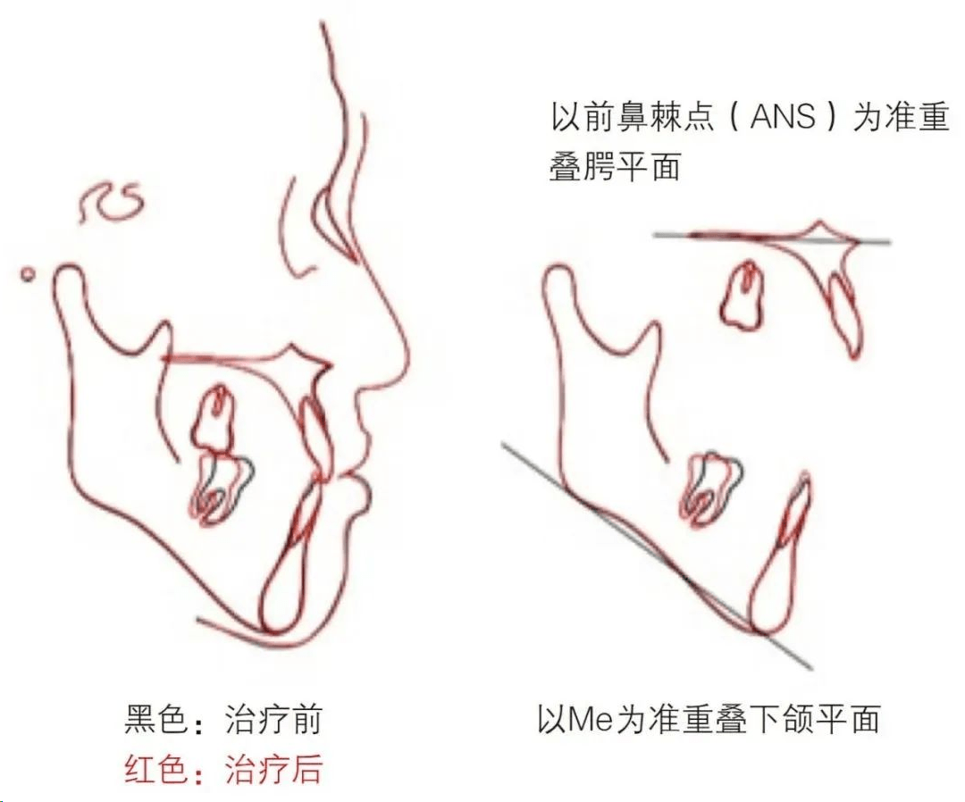 图14 治疗前和治疗后头颅侧位片的整体,上颌与下颌重叠图;可见上下颌