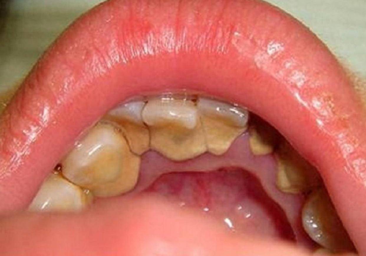 教你三招彻底去除,脏牙垢哗哗掉!_牙齿_口腔_饮食