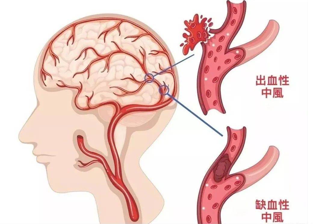 月中风的功效和图片图片