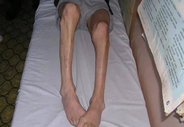 运动神经元病的常见症状表现都有哪些?应该怎么办呢?_患者_肌肉_发展