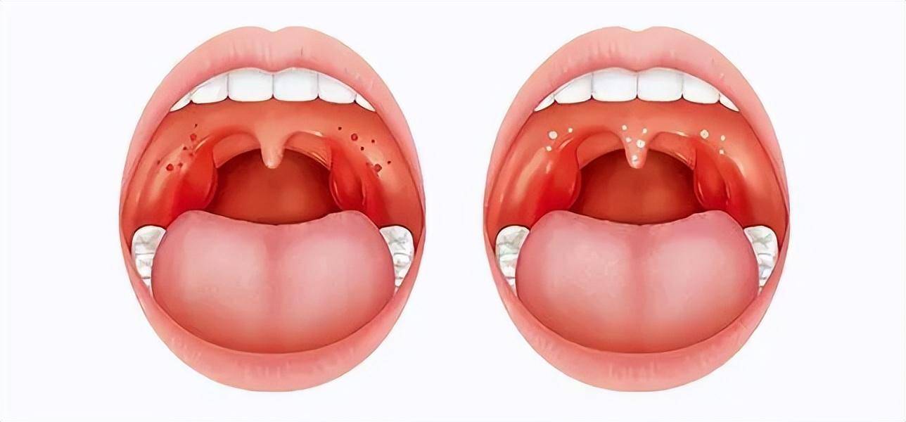 日常做好7个预防,远离肿大困扰_咽喉_症状_医生