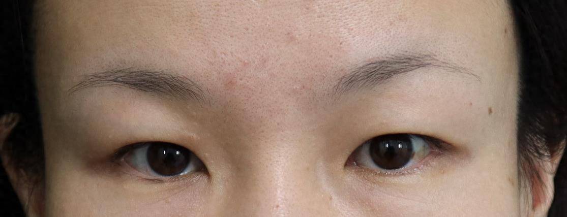 我的眼眶骨较低,眼睛浮肿,双眼皮手术后会显得很凶吗?