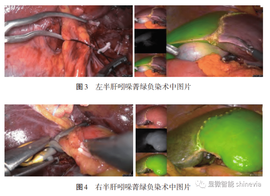 共识解读 | 吲哚菁绿荧光成像技术在肝脏外科的应用