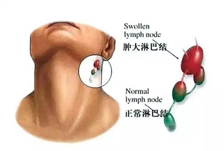 淋巴结肿大怎么办?是这6原因引起的