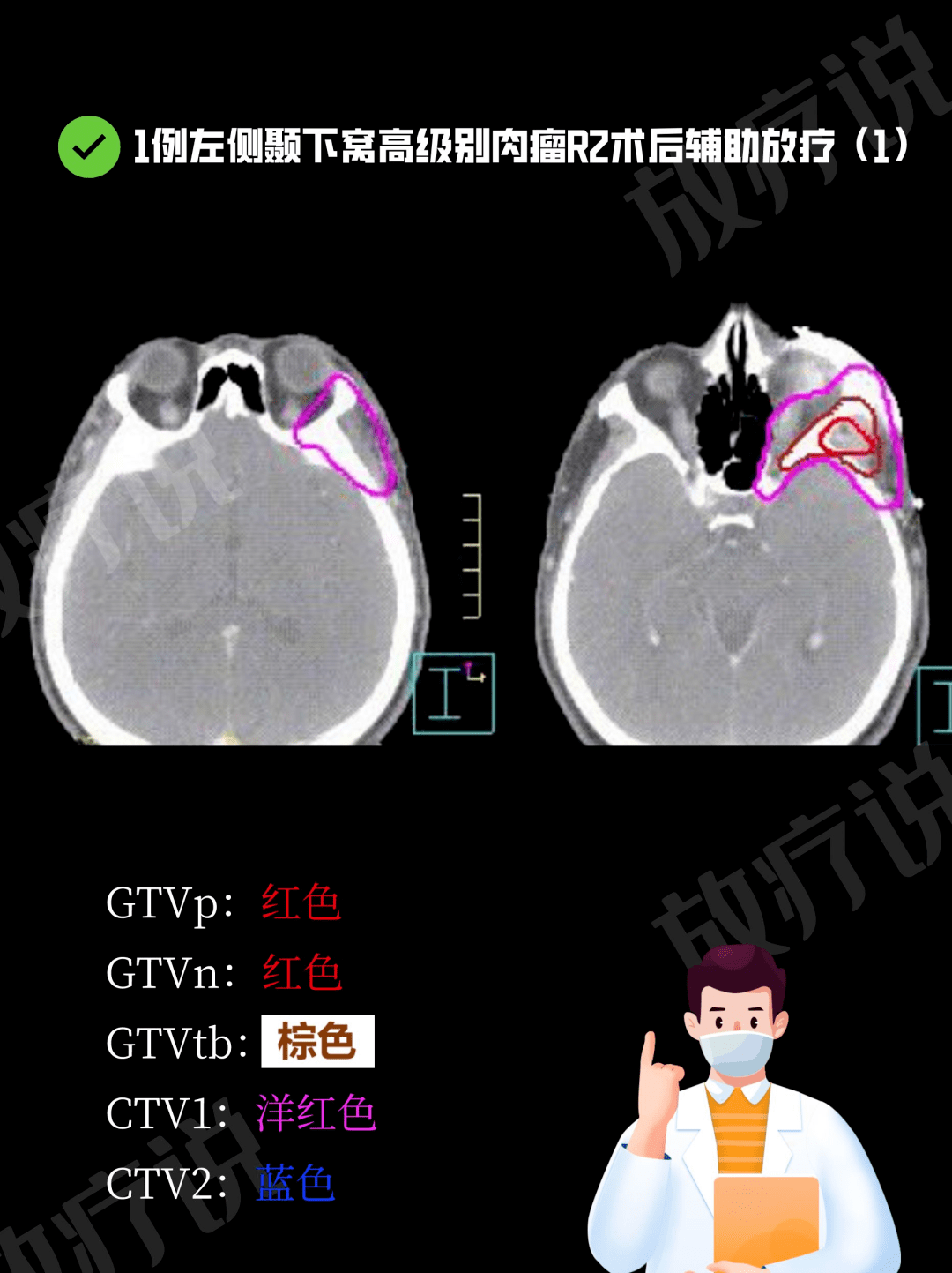 颞下窝肿瘤图片