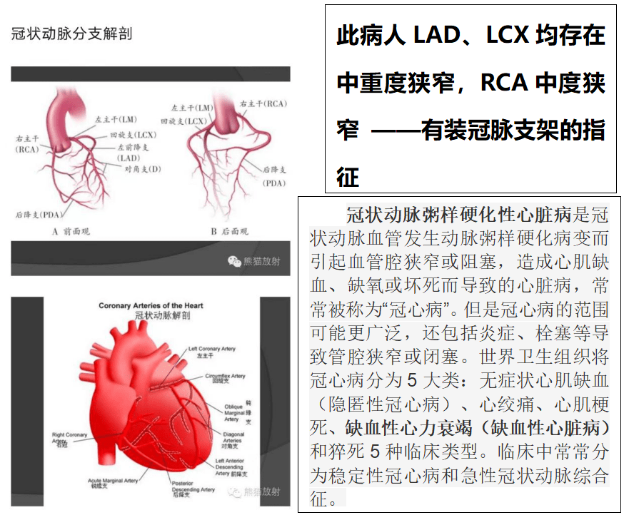 冠脈造影報告左室射血分數才31%(正常參考值:50%-70%);左室增大;節段