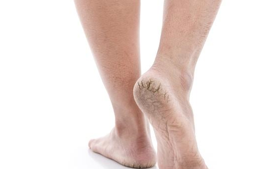 出现"脚后跟干裂",是什么原因引起的?可能与这3件事有关!