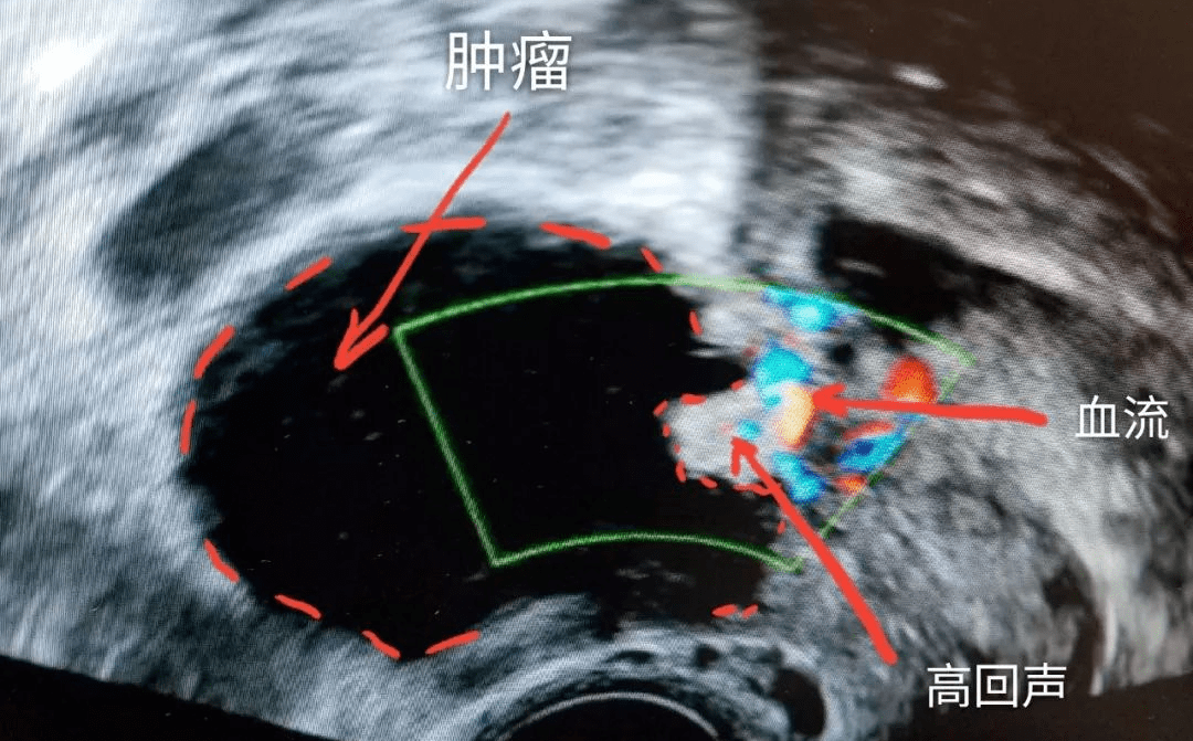 卵巢良性腫瘤類型很多,包括來源於上皮的漿液性或者粘液性囊腺瘤以及