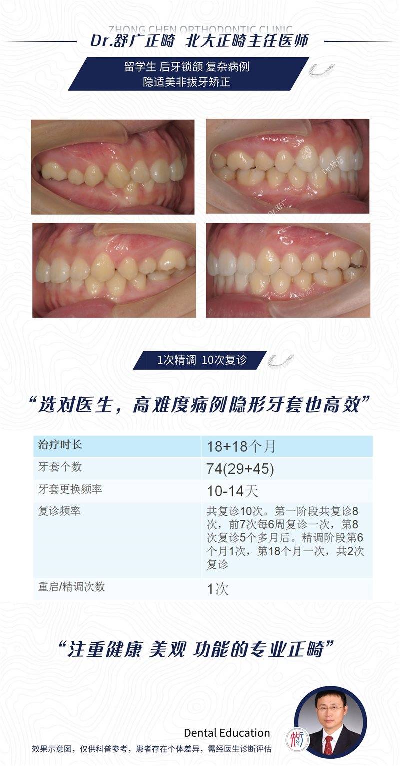 ⑤ 舒廣主任多顆後牙鎖頜隱適美矯正,無重啟,精