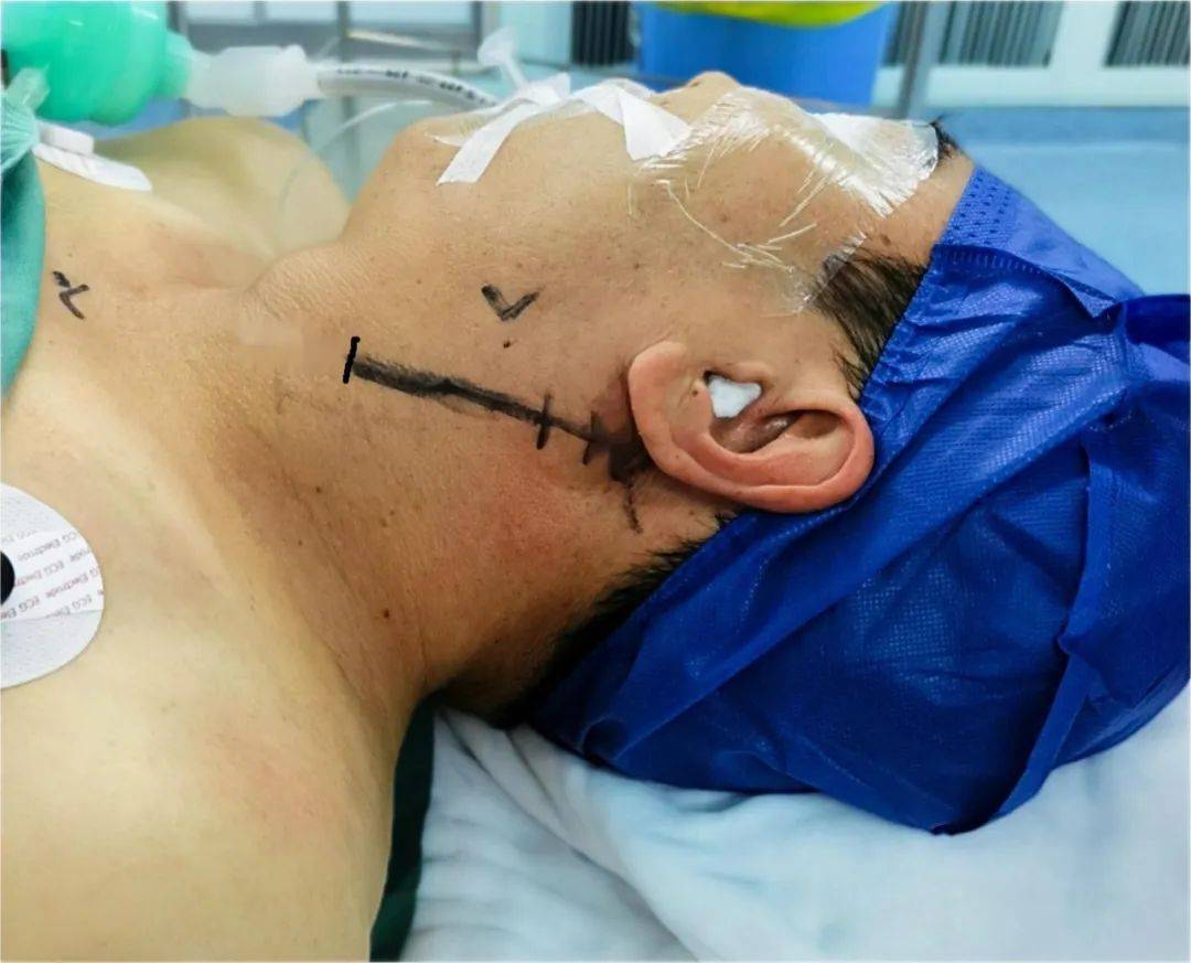 医者解读|杂交手术室实现颈内动脉闭塞患者颈内动脉再通_血管_治疗