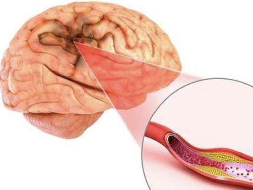 很多人對腦血管病有個錯誤的認識:覺得腦血管出現問題都是毫無徵兆的