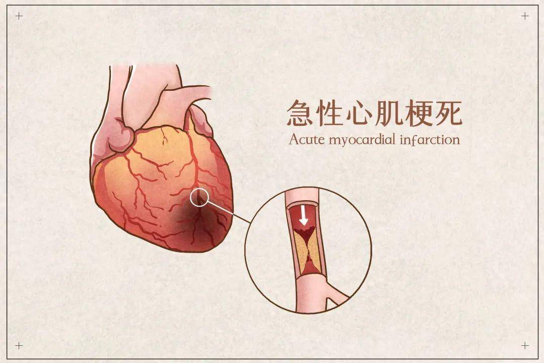 第四版心肌梗死全球統一定義,將急性心肌梗死分為5種類型:i型,原發性