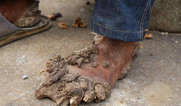 湖南男子身患怪病20多年,手脚长满树枝还能开花,这是怎么回事?