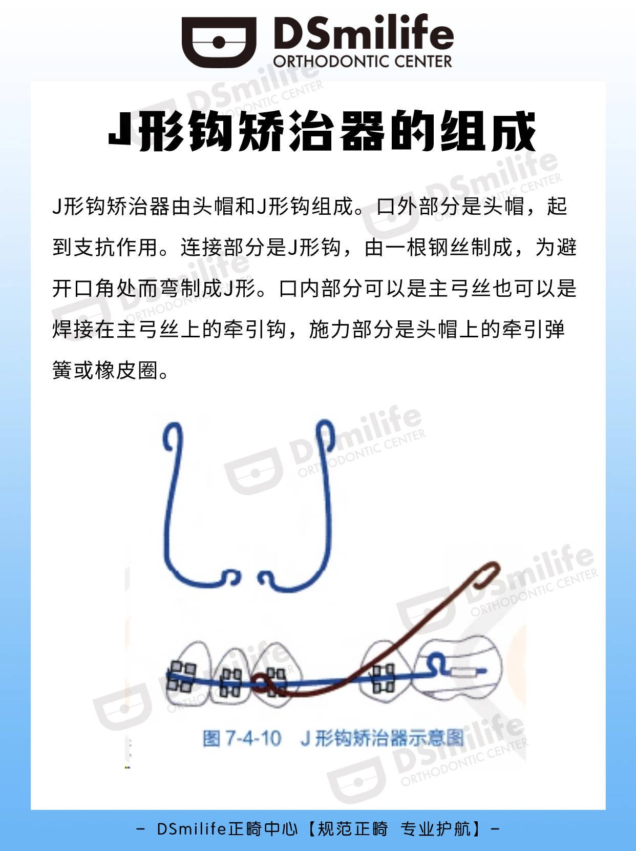 正畸垂直牵引示意图图片