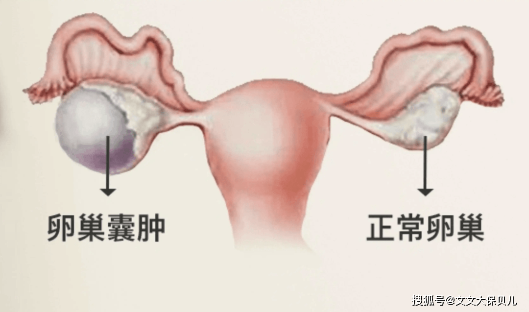 畸胎瘤手术后,还能正常买保险吗?_肿瘤_卵巢_标志物
