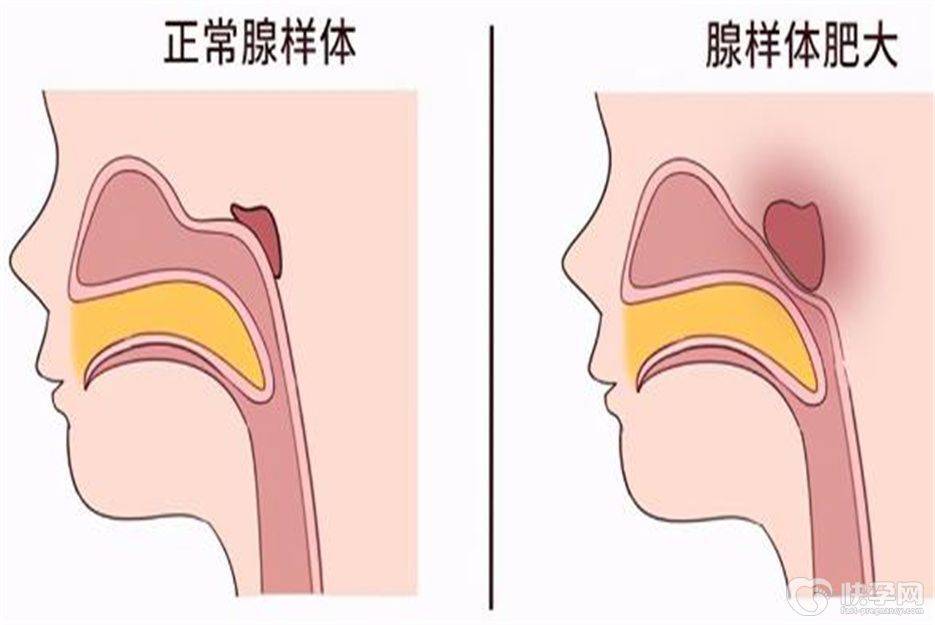 腺樣體肥大的危害?