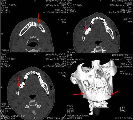 下頜骨雙側骨折左上:顎骨骨折左下:上頜竇前壁骨折右下:上頜骨額突