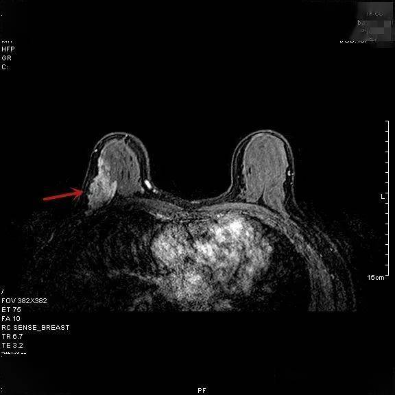 當時有咳嗽症狀,入院查乳腺彩超及mri如下所示:前期檢查治療情況及