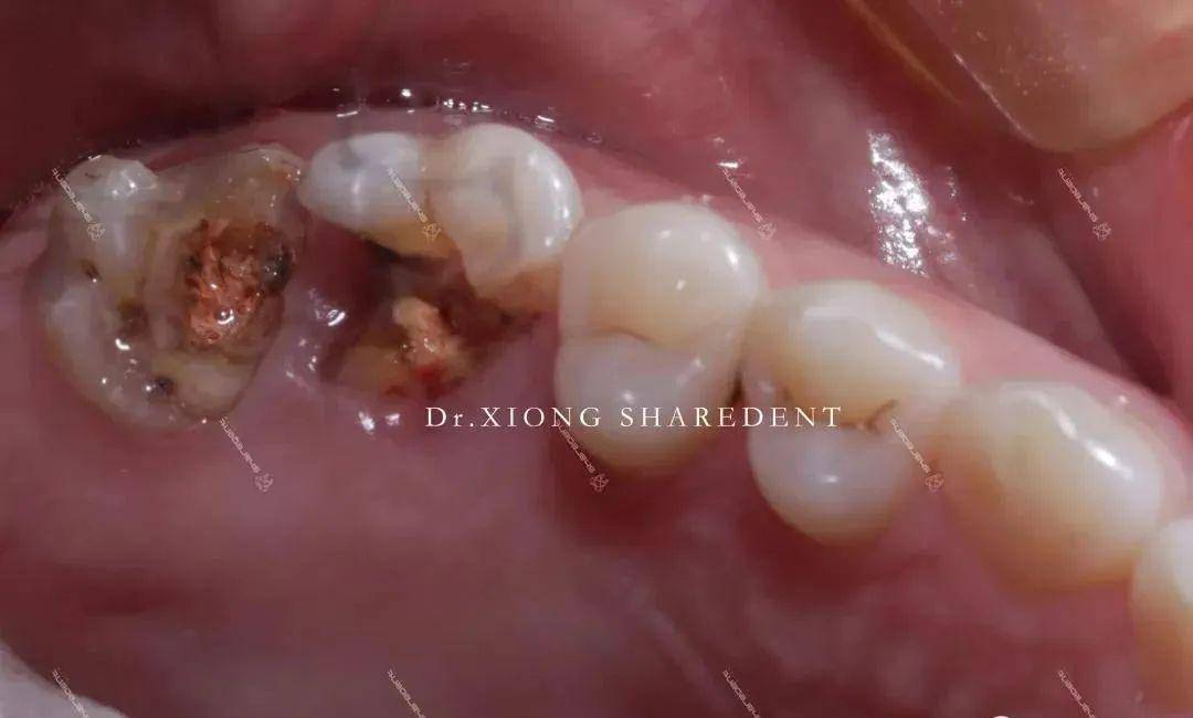 左上后牙残冠显微根管再修复一例
